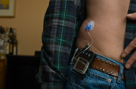 A male torso showing where he attaches the insulin pump to his side