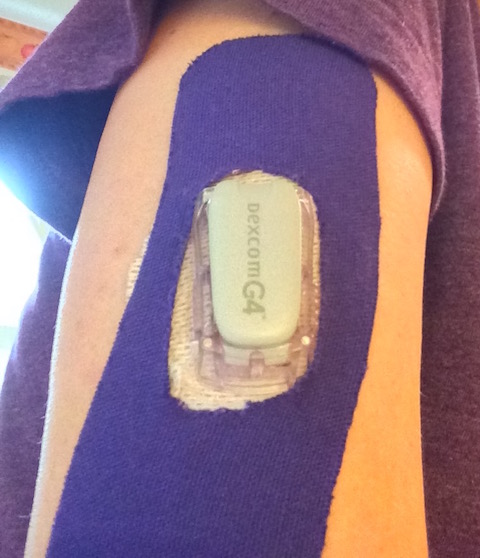 A person's arm showing how the individual uses K-TAPE to keep her Dexcom G4 CGM attached to her skin