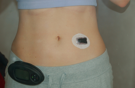 A female torso showing how she attaches the CGM to her body with adhesive